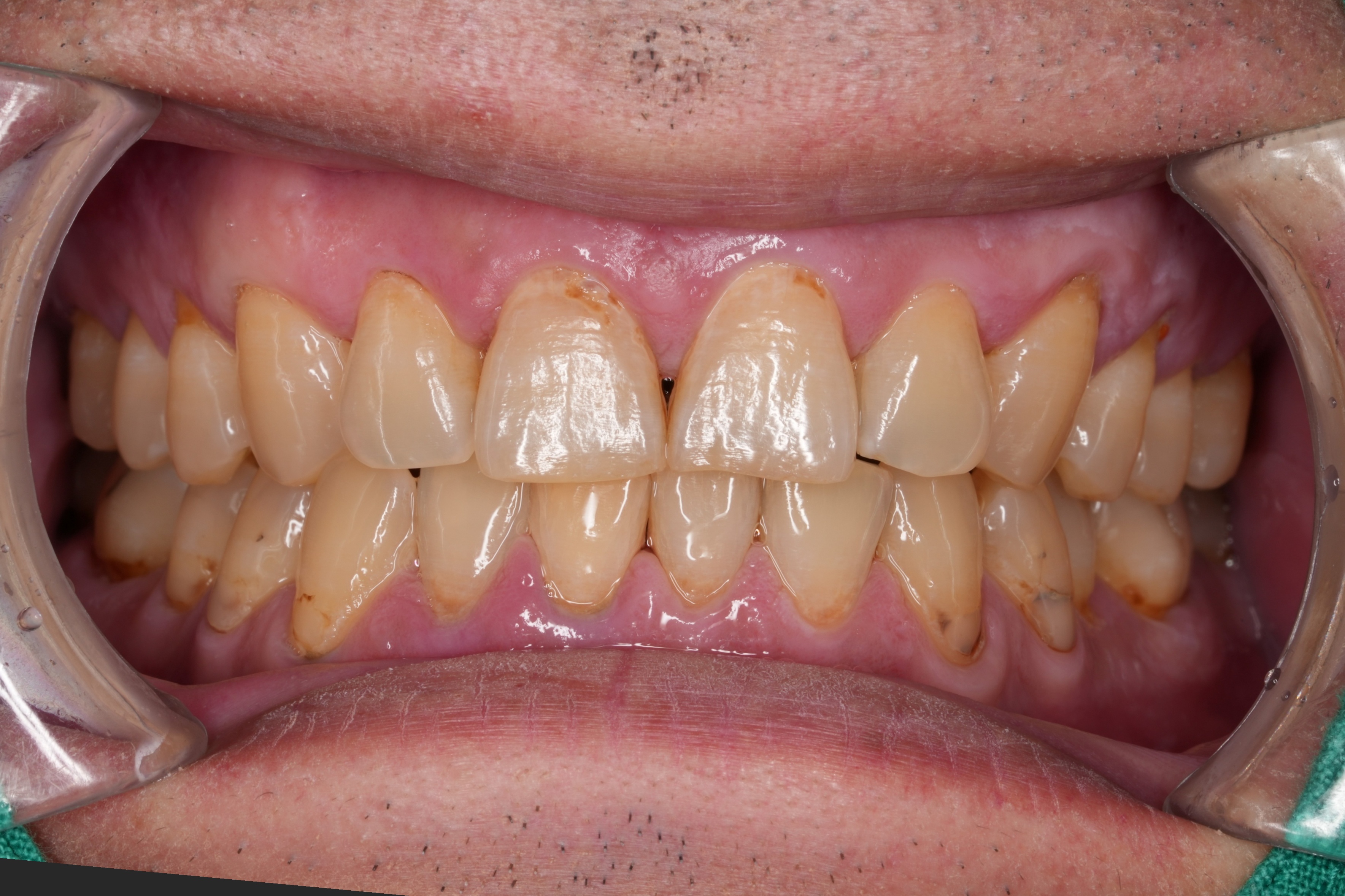 상악 전치부 치경부 충치치료 구강 비포