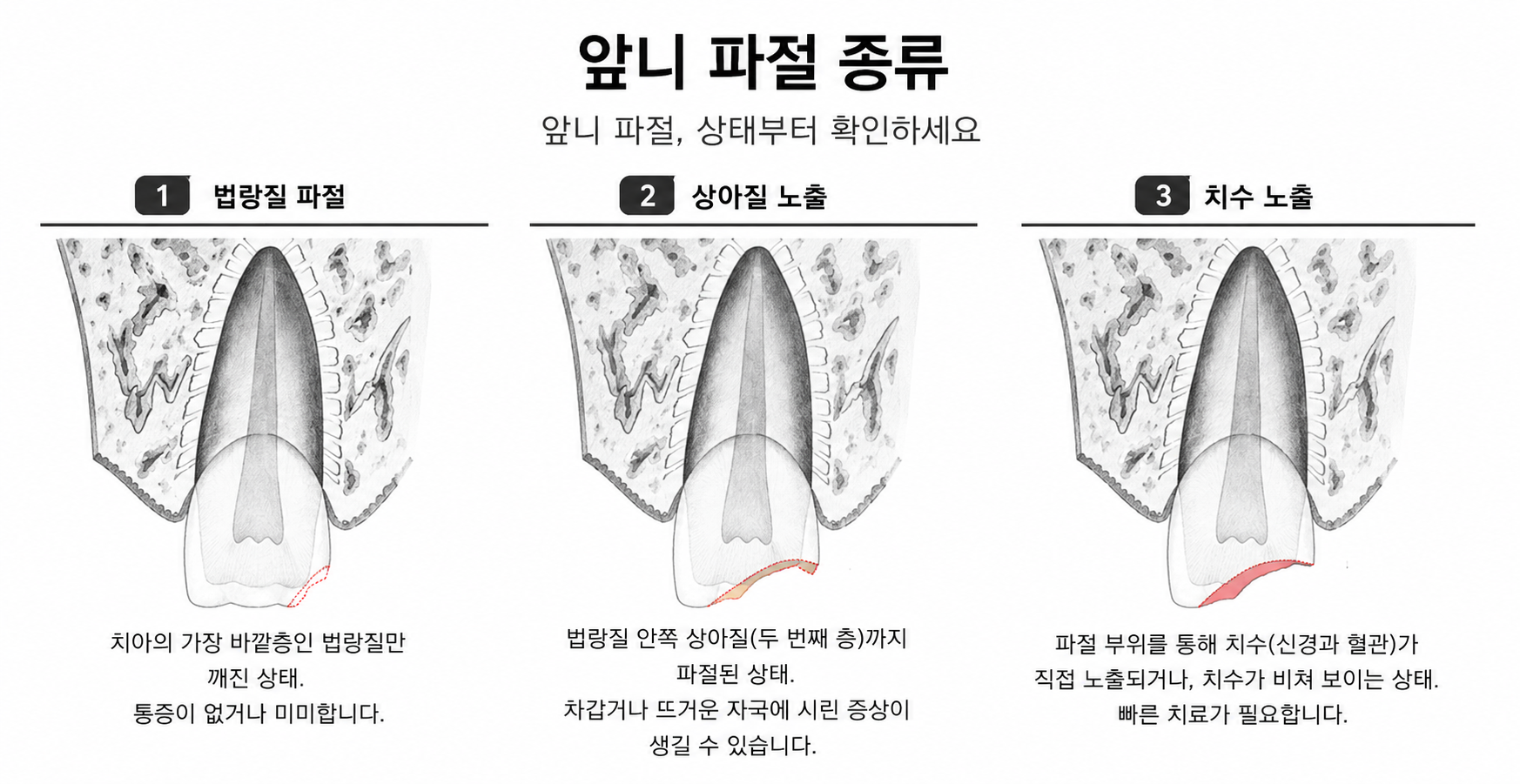 명지동 치과 | 앞니가 깨졌어요 — 레진·크라운 티 안 나게 복구하는 방법 총정리 (2026) - 이미지 2