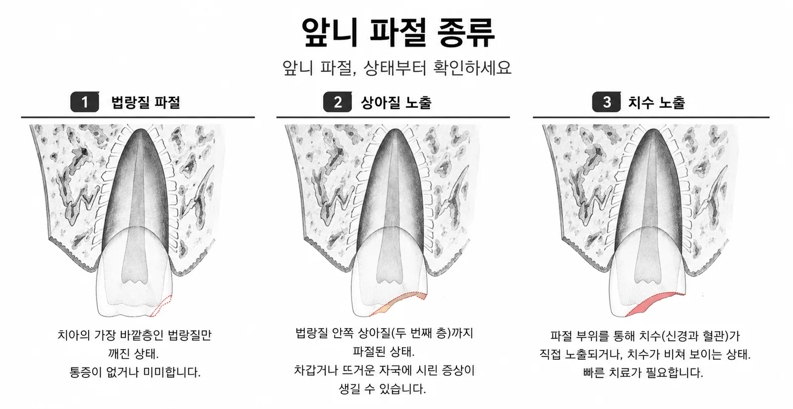 명지동 치과 | 앞니가 깨졌어요 — 레진·크라운 티 안 나게 복구하는 방법 총정리 (2026) - 이미지 2