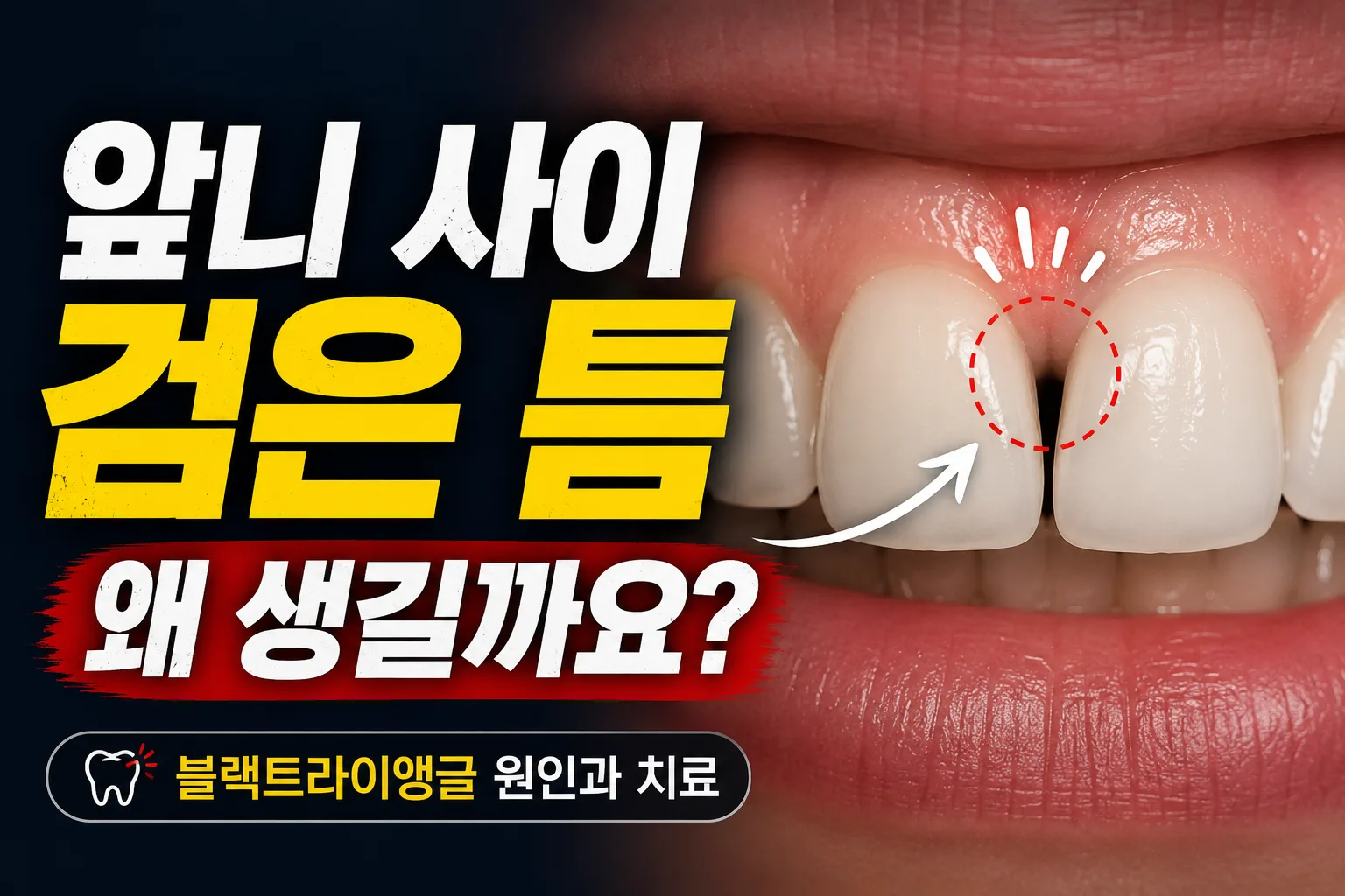 명지동 치과 | 앞니 사이 검은 삼각형(블랙트라이앵글) — 원인과 치료 방법 총정리 (2026)