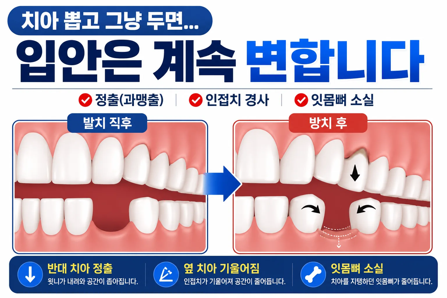 치아를 뽑고 그냥 두면 어떻게 될까요? 발치 후 방치하면 생기는 3가지 변화 | 부산 명지 치과