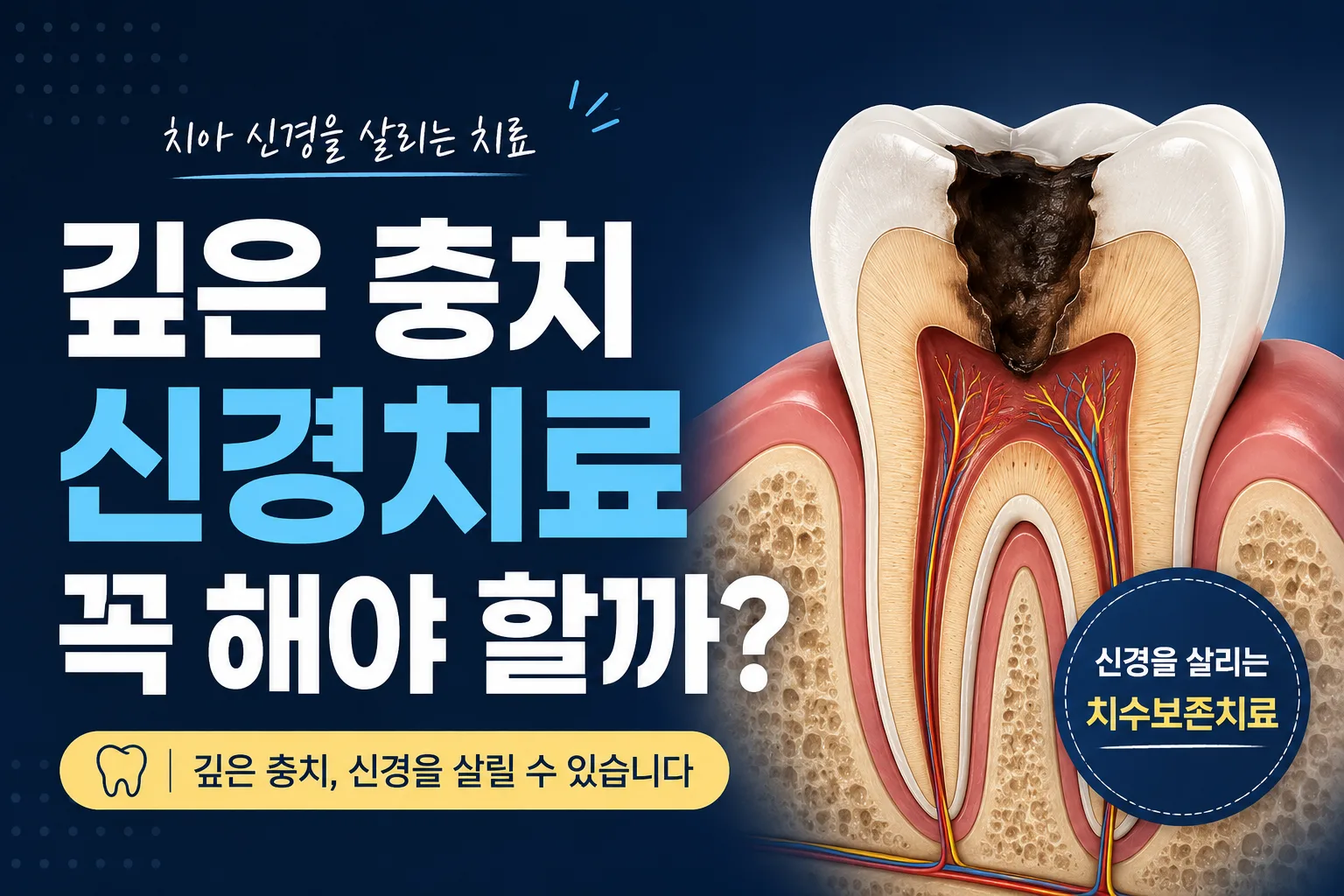 깊은 충치, 신경치료 없이 치료할 수 있을까요? | 부산 명지 치과