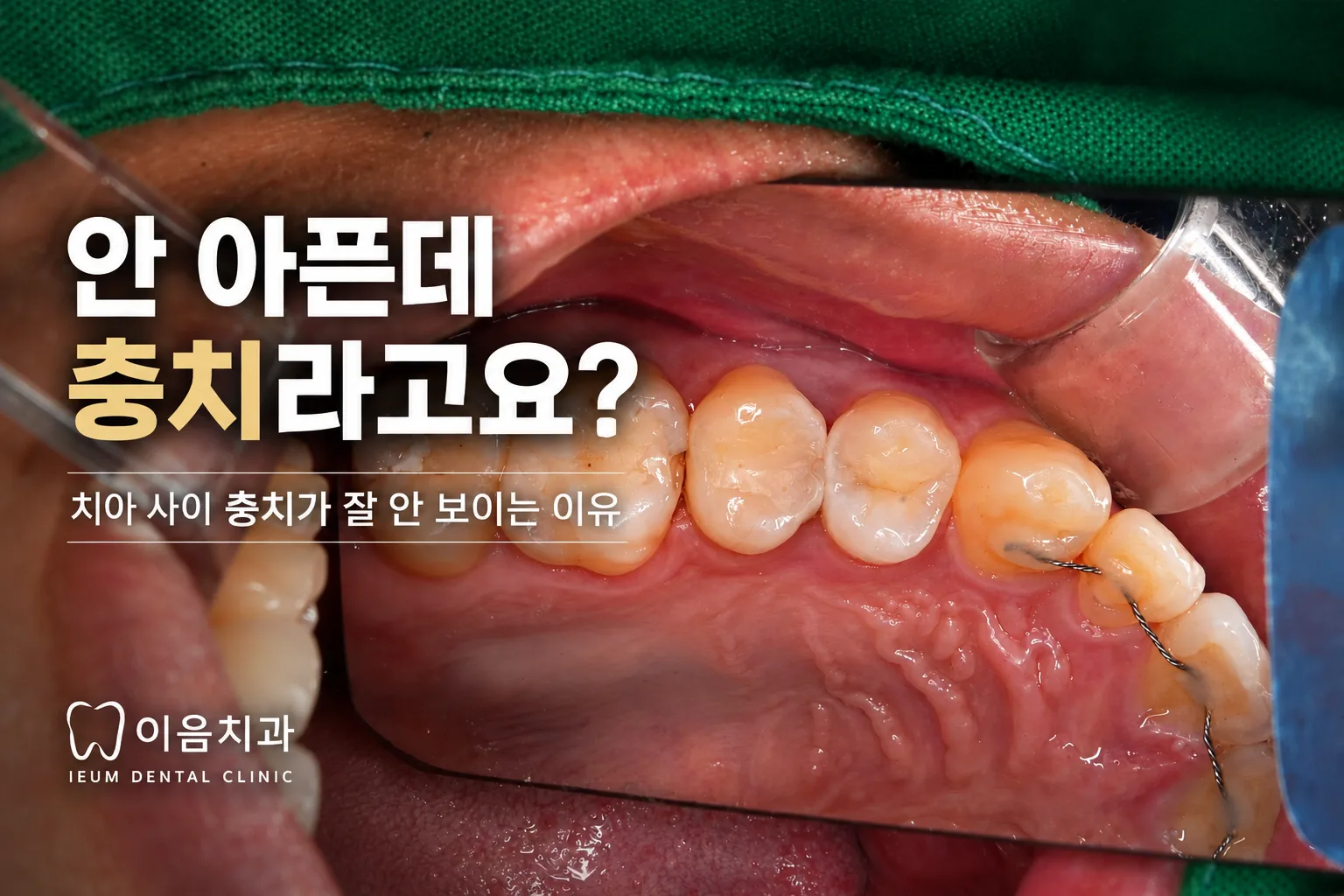 겉으로 멀쩡한데 충치라고요? 치아 사이 충치가 숨어 있는 이유 | 부산 명지 치과